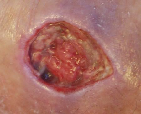 WOUND11-24-08.jpg