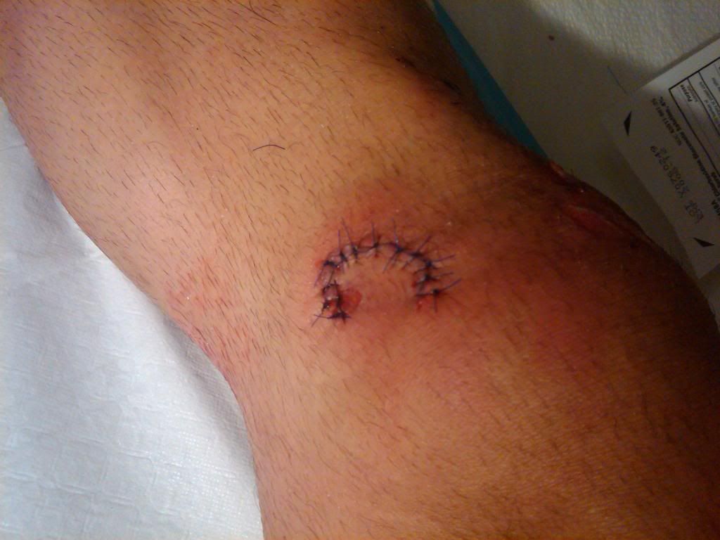 http://i197.photobucket.com/albums/aa48/chrisgleason/Cuse/legstiched-1.jpg