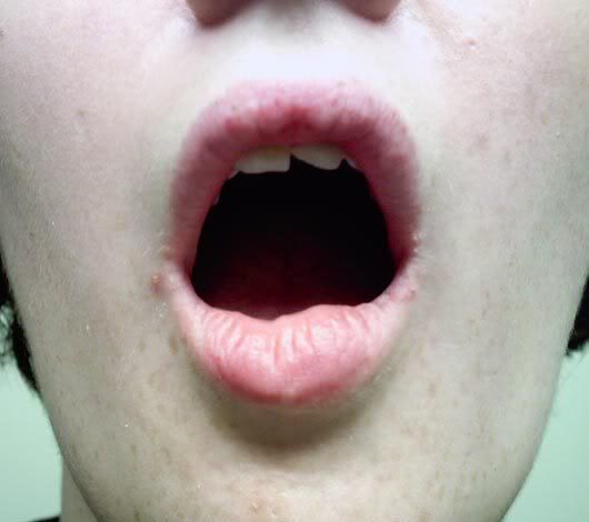Herpes 2 transmitted orally